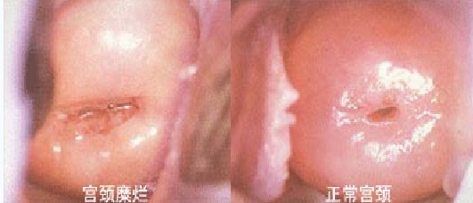 宫颈糜烂图
