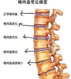 腰间盘突出的症状