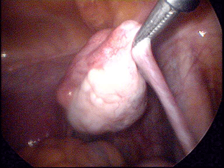 石女先天性无阴道