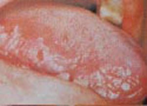 妇女外阴白斑图片溃阳