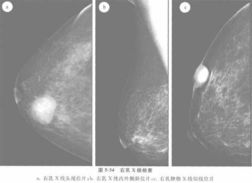 乳腺纤维瘤道图