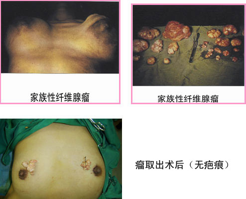 乳腺纤维瘤图片