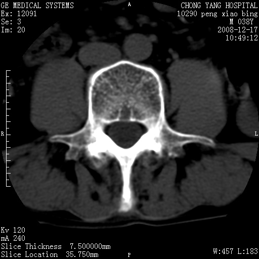 强直脊柱炎CT/MRI道图