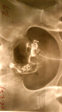 正常的输卵管造影图