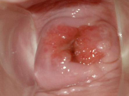 宫颈糜烂2度图片