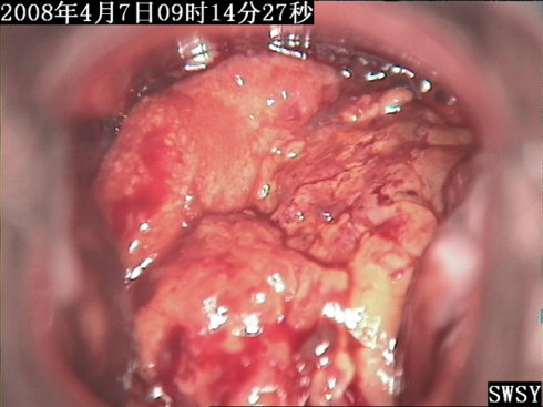 子宫癌晚期图片