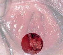 宫颈湿疣的图片