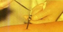 皮下埋植避孕手术图片
