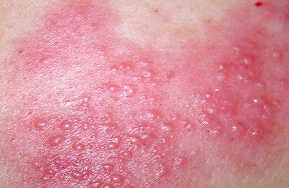 女性生殖器疱疹照片