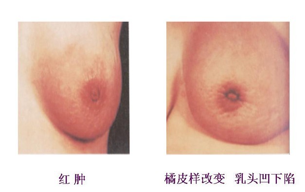 乳腺囊肿的图片