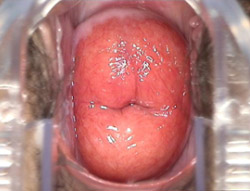 三度重度宫颈糜烂图片
