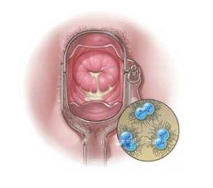 女性淋病早期症实物图片