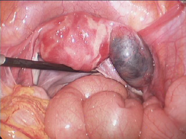 宫外孕早期症状图片