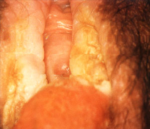 外阴白斑图片大全