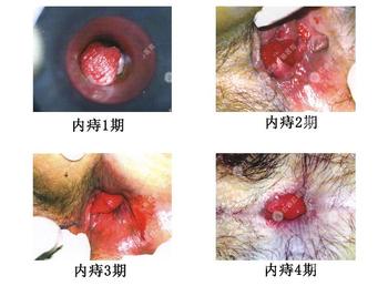 内痔疮图片