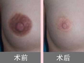 红色乳晕图片，黑色乳晕图片