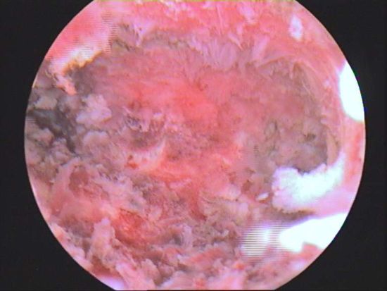 子宫肌瘤内膜息肉图片