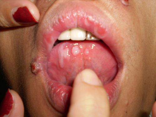 舌癌早期症图片