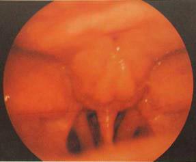 鼻咽癌的早期症状图片