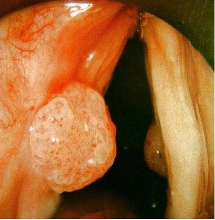 喉癌的早期症状图片