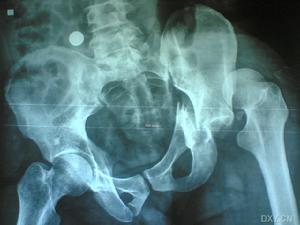 腰间盘突出症状图片