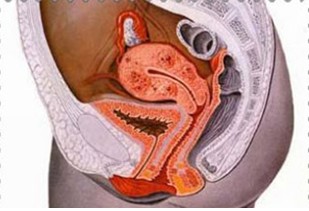 女性盆腔炎侧图