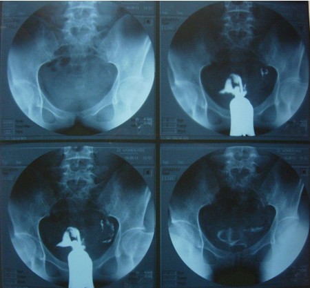 输卵管造影成影图片