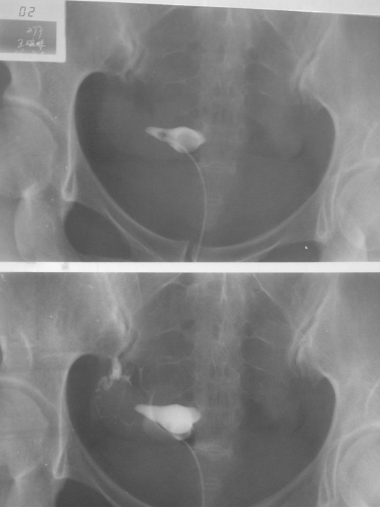 输卵管造影X图片