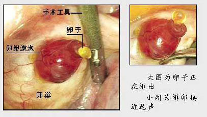 
多囊卵巢综合症怀孕