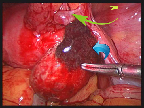 子宫肌瘤左则图片